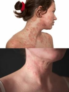 dermatitis atópica en mujer en cuello y pecho
