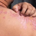 dermatitis en espalda